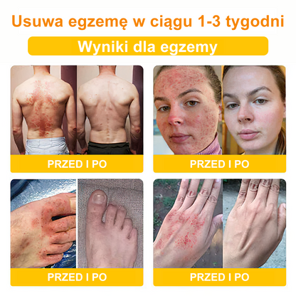 🌼💁 ♀️Krem przeciwbakteryjny do usuwania jadu pszczół Velisse™ Bee Venom – leczy wiele chorób skóry (zalecany ADD)